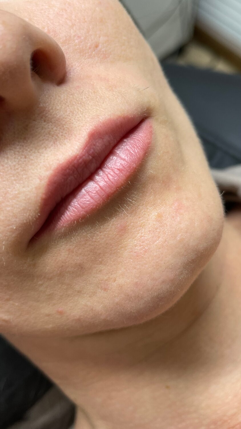 губы, увеличение губ, пластика губ, губы гиалуроновой кислотой, аугментация губ