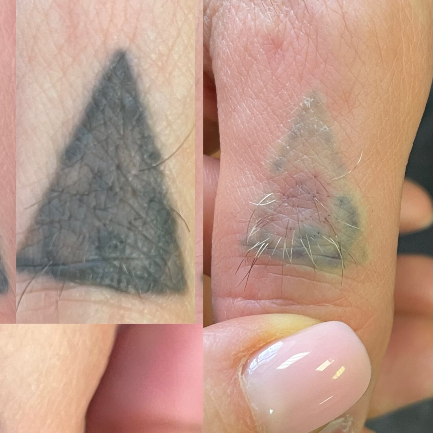 удаление татуировок лазером, лазерное удаление татуировок, удаление татуировок, удаление тату, удаление тату лазером