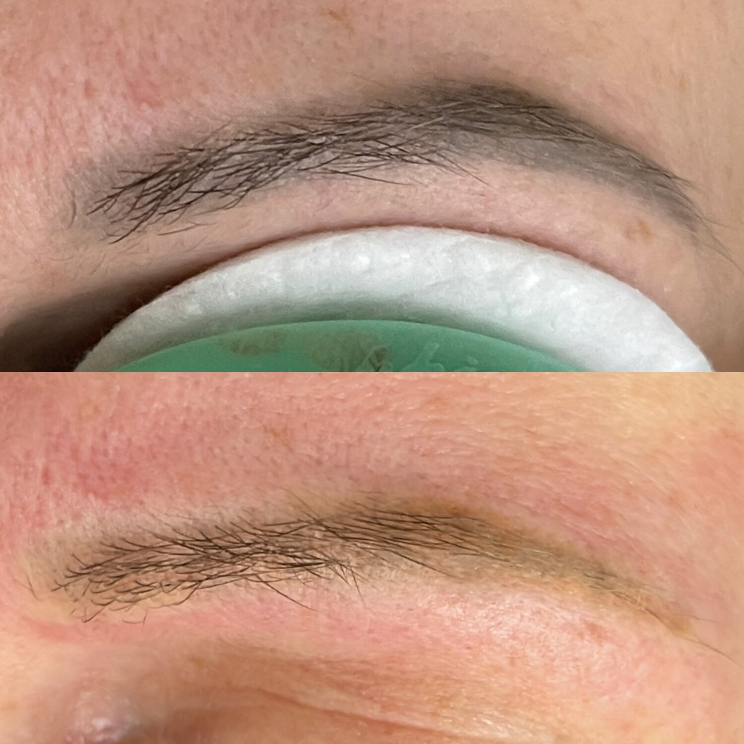 лазерное удаление татуажа бровей, лазерное удаление бровей, татуаж, татуаж брови, микроблейдинг бровей