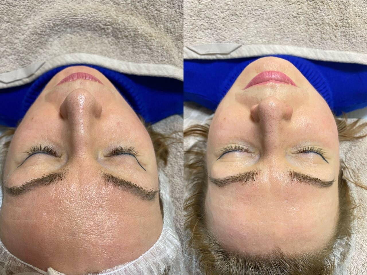 комбинированная чистка лица, процедуры для лица, уз чистка лица, гидропилинг лица, чистка лица