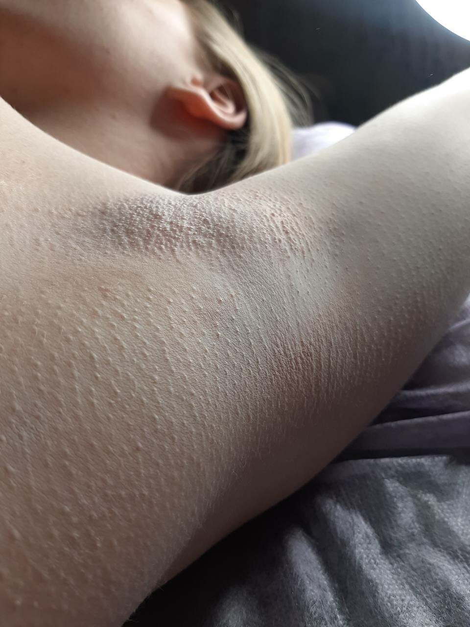 депиляции, шугаринг, подмышечная впадина, подмышка, депиляция сахаром