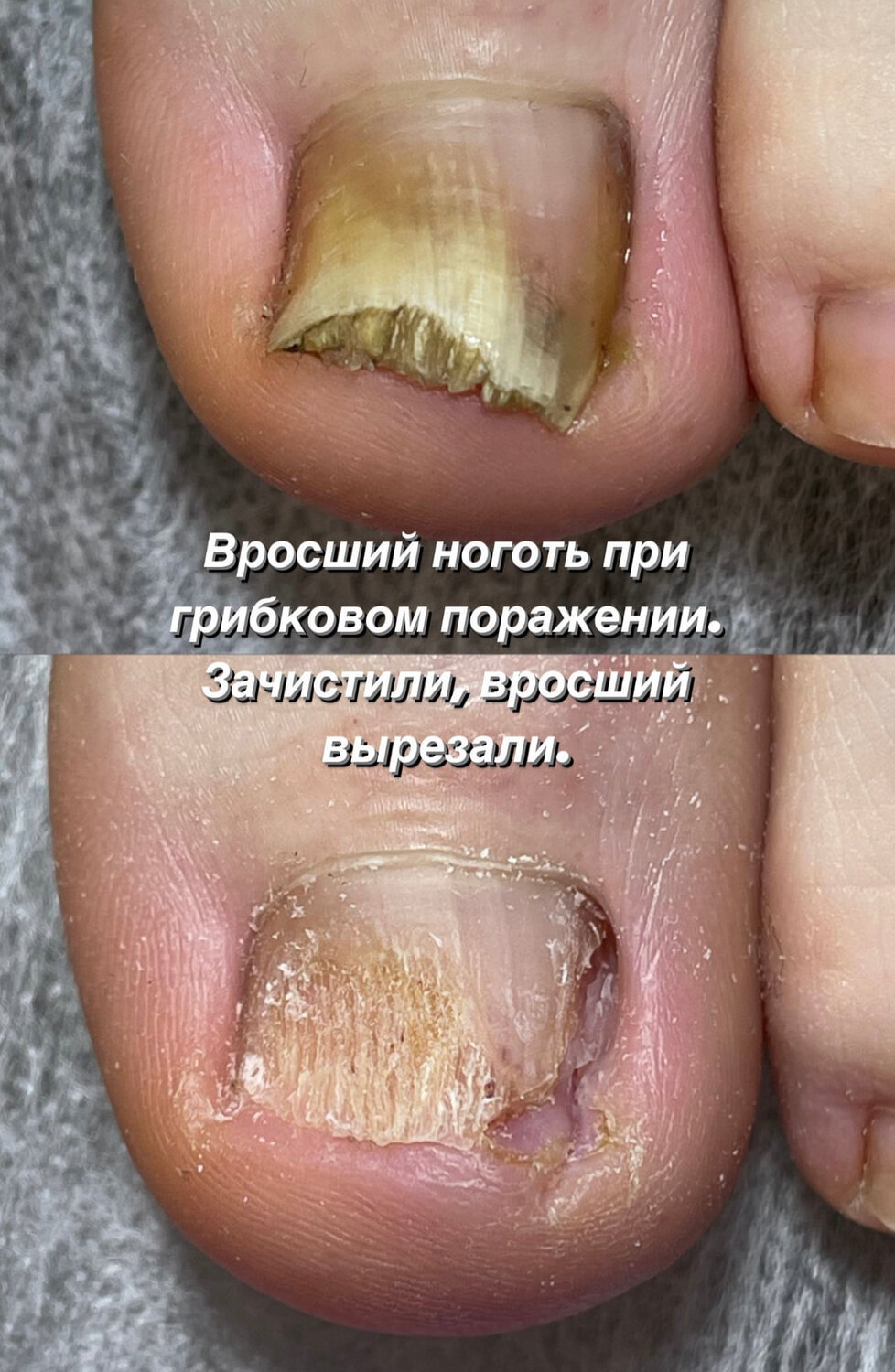 грибковое поражение ногтей, онихомикоз грибковое поражение ногтей, лечение грибка ногтей, виды начального грибка ногтей, поражение ногтей