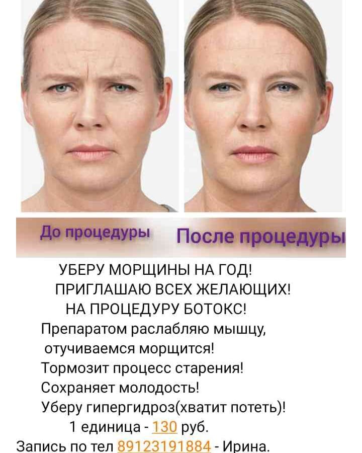 типы старения таблица, ботокс в межбровье последствия, ботокс для лица, возрастные изменения кожи лица