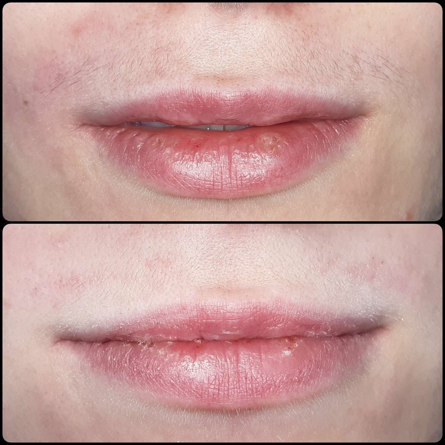 губ, восстановление контура губ, контур губ, асимметрия губ, татуаж очень тонких губ
