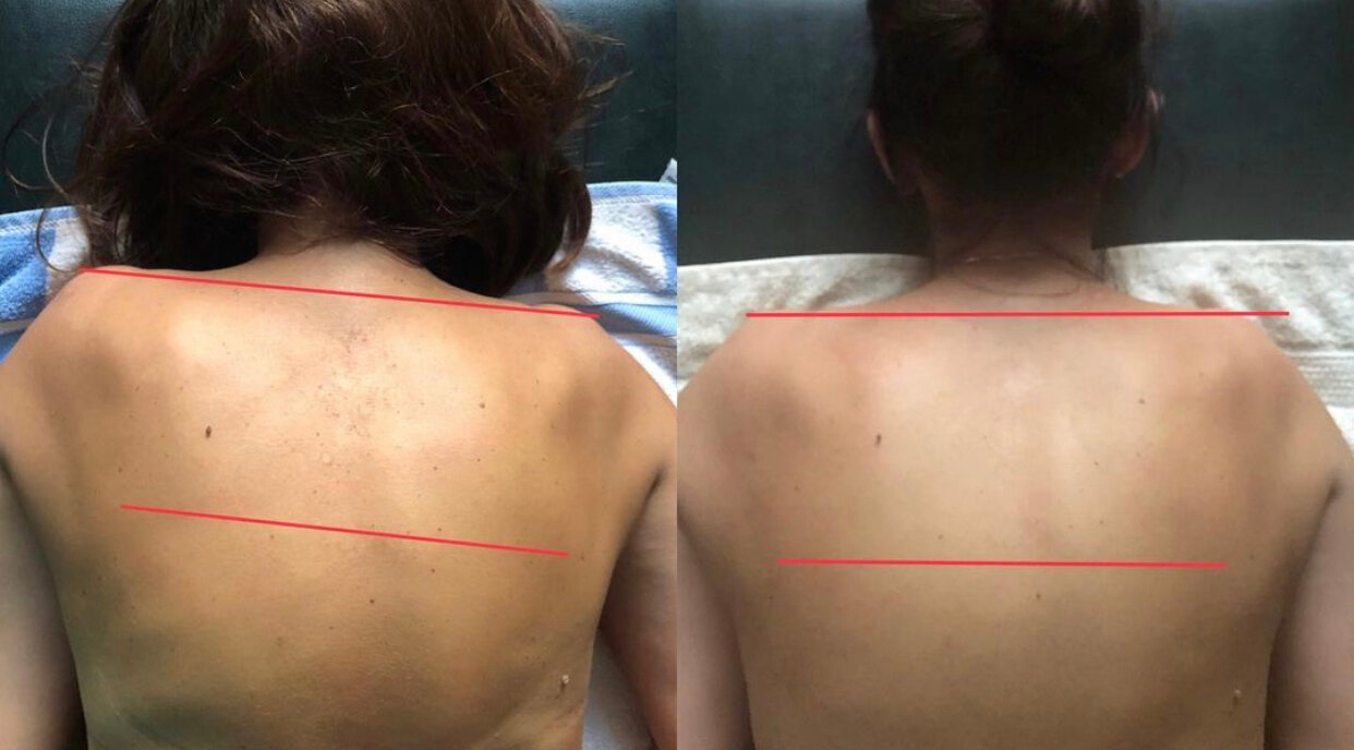 идиопатический сколиоз 3 степени, сколиоз, на спине, лечение сколиоза, сколиоз 2 степени + лордоз