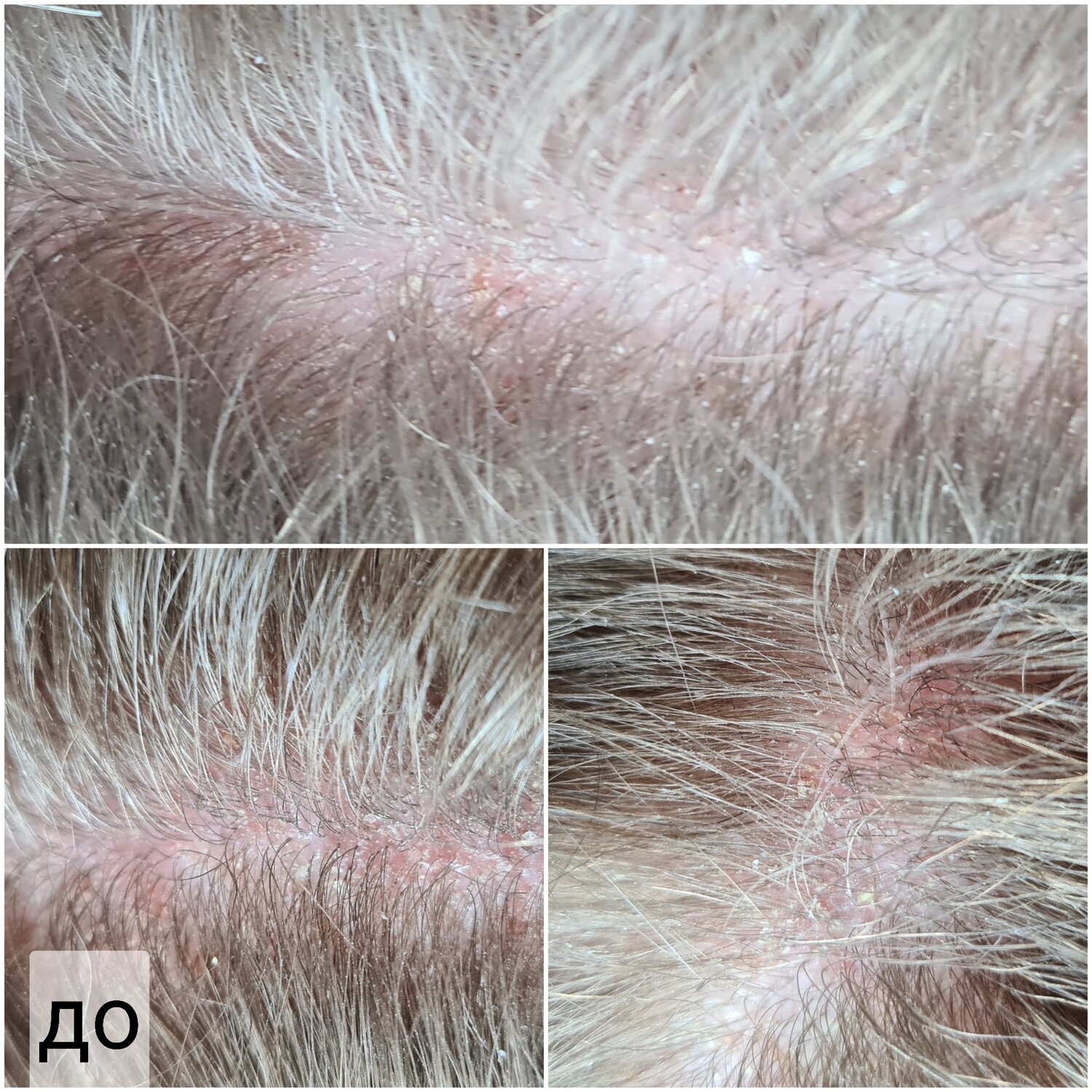 перхоть, волос, lichen planopilaris кожи головы, себорея, себорейный дерматит