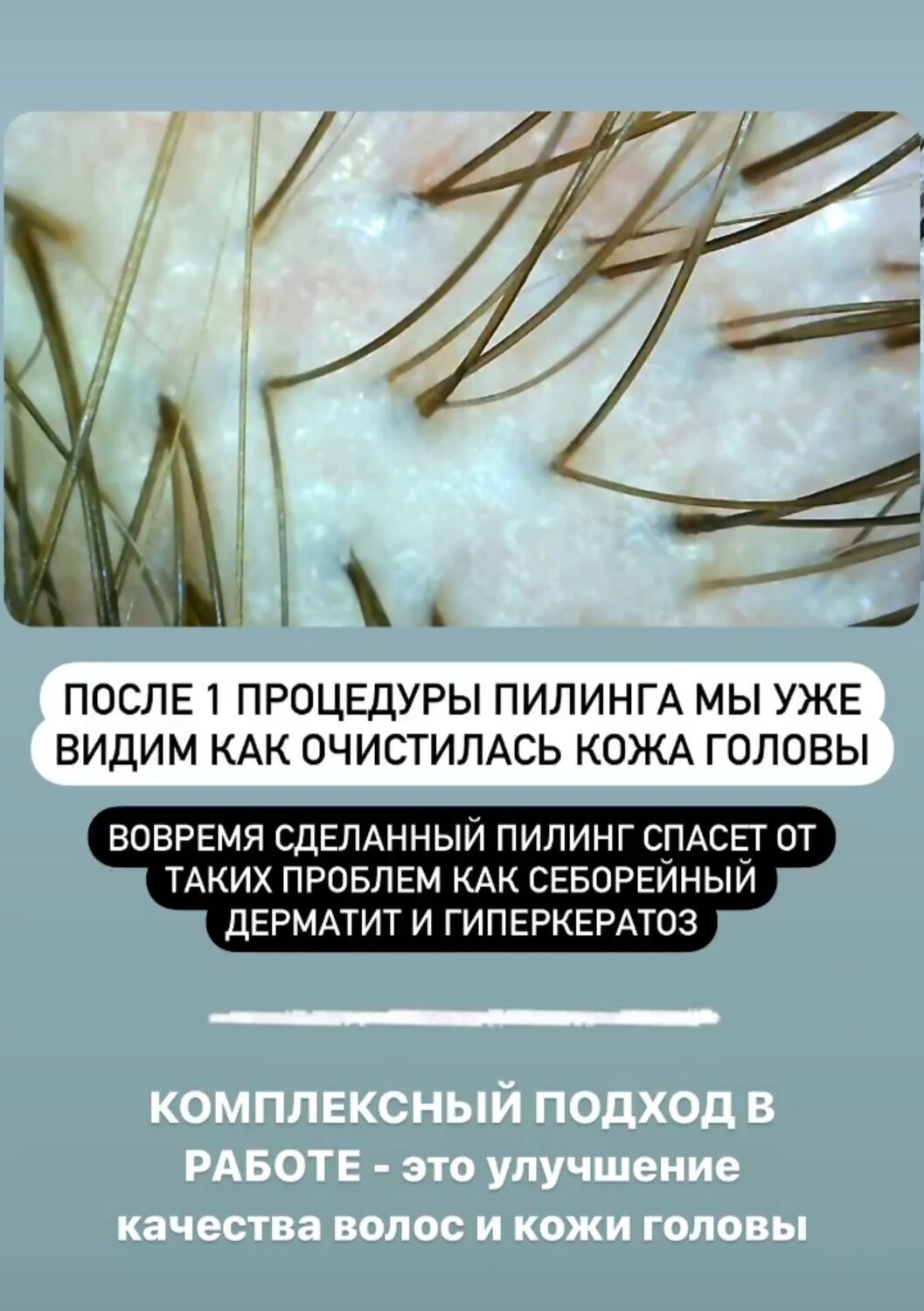 пилинг кожи головы до и после, пилинг кожи головы под микроскопом, пилинг, пилинг для кожи головы, кожа головы под микроскопом