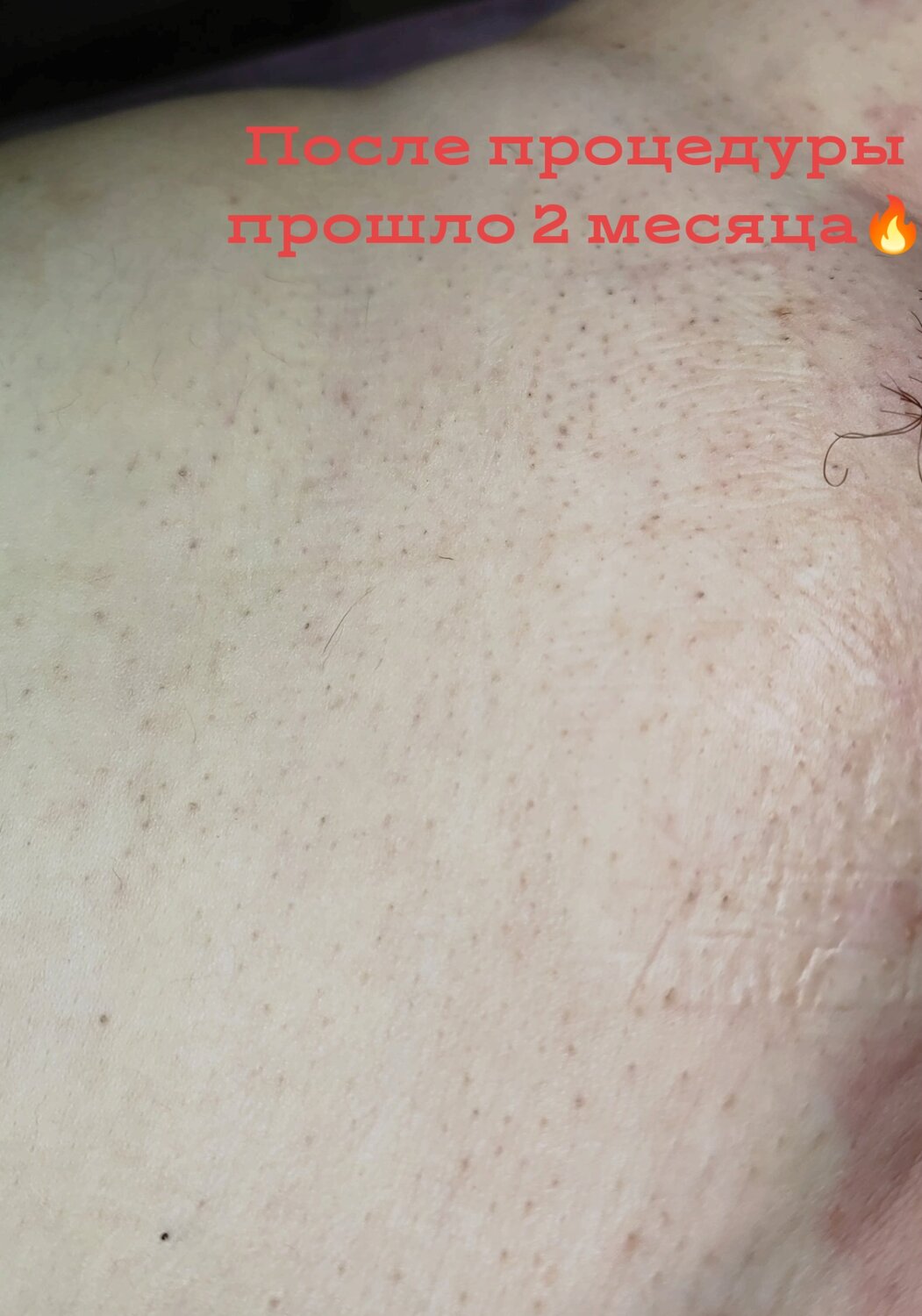 восковая депиляция, электроэпиляция зоны бикини, эпиляция, электроэпиляция, элос эпиляция