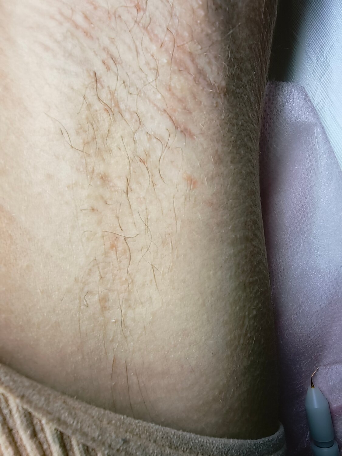 электроэпиляция, шугаринга, шугаринг депиляция, восковая депиляция, депиляция