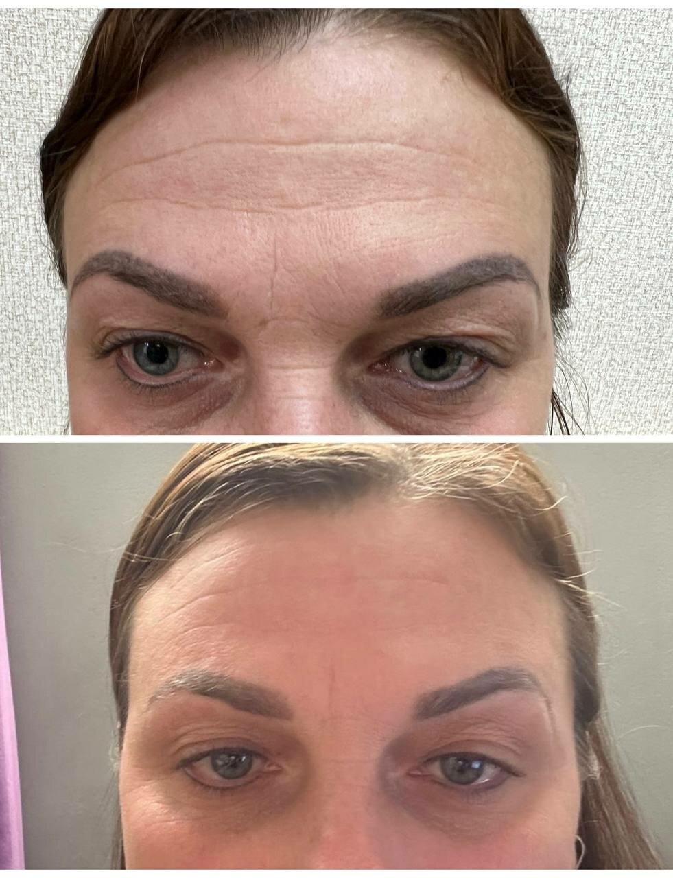 ботокс для лица, ботокс в лоб, ботокс между бровей, межбровье, лицо сразу после ботокса
