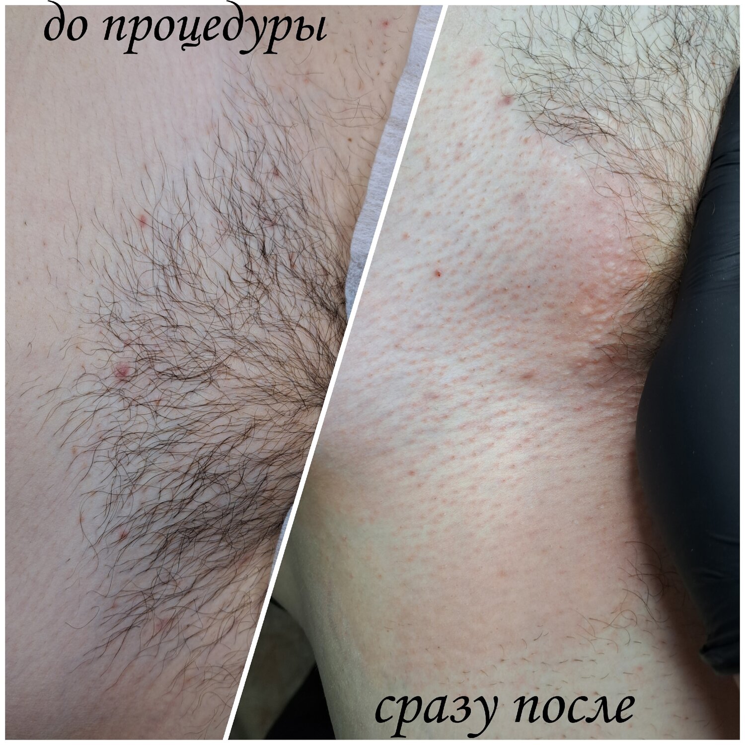 электроэпиляция, восковая депиляция, электроэпиляция зоны бикини, эпиляция, эпиляция воском