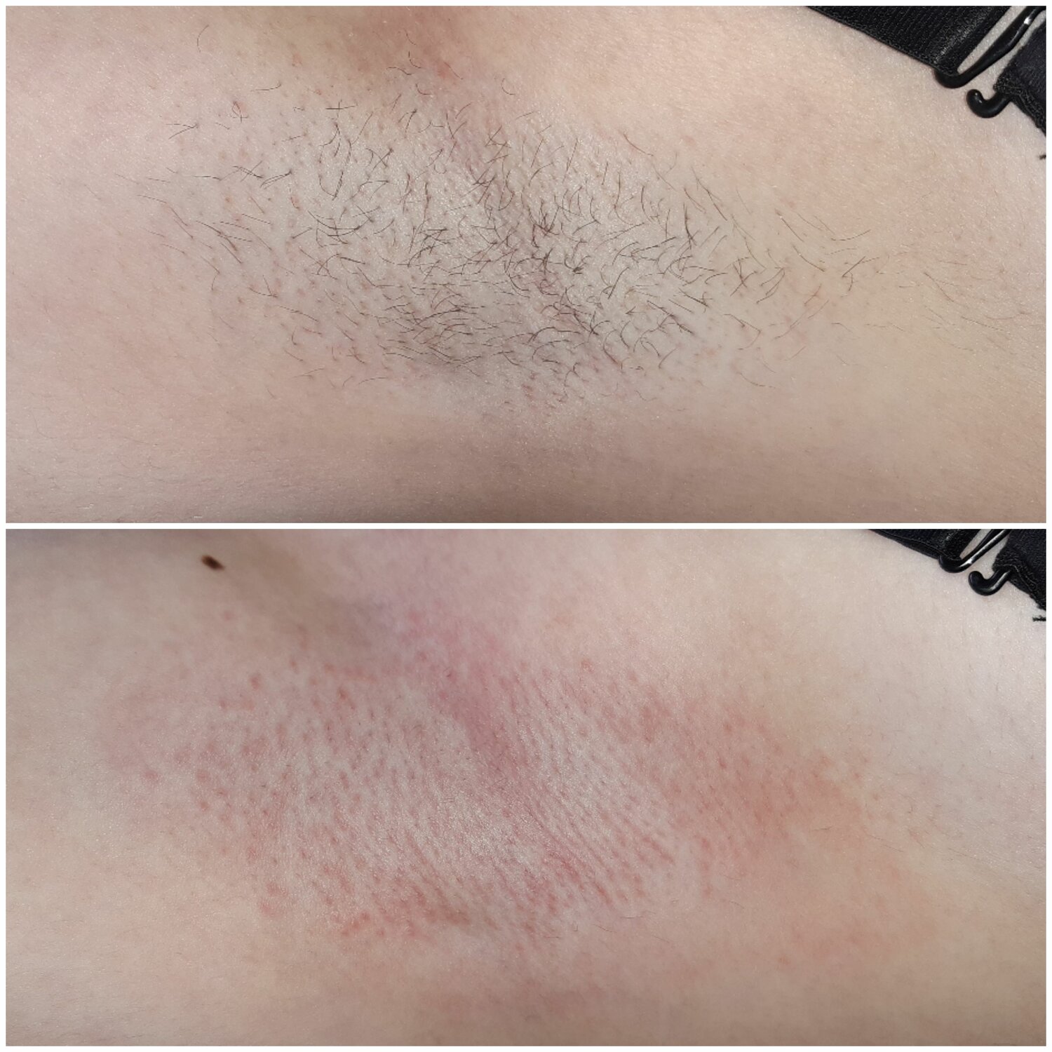 электроэпиляция, электроэпиляция глубокое бикини, электроэпиляция бикини, эпиляция глубокого бикини, эпиляция классическое бикини