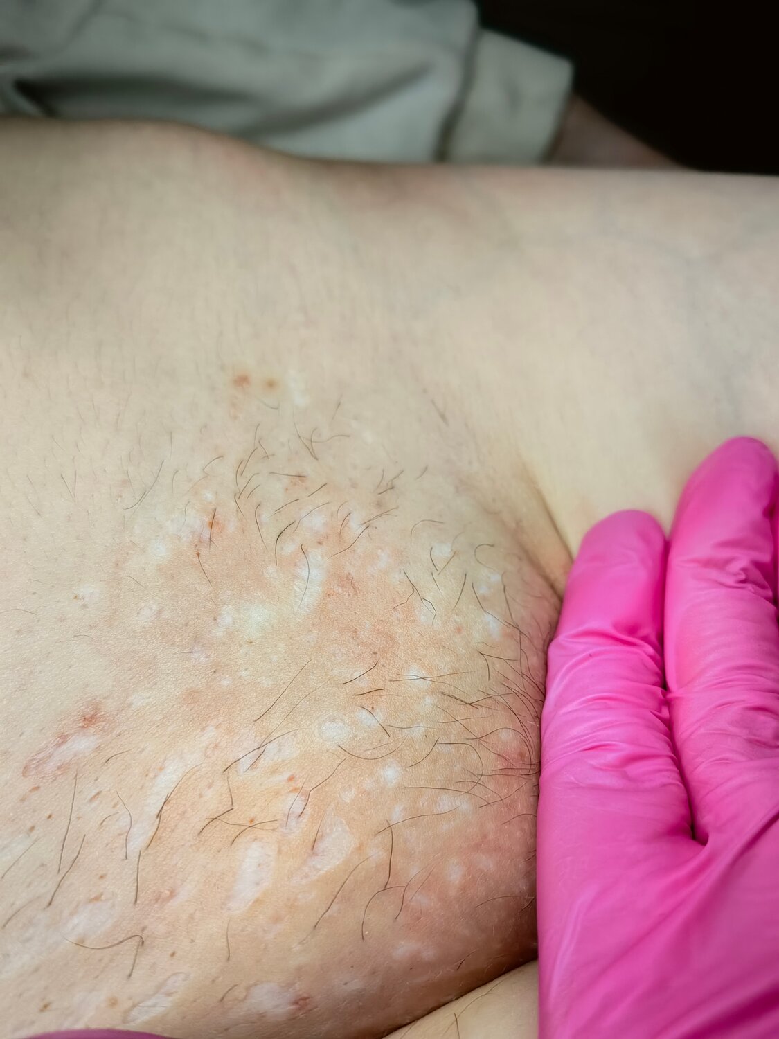 восковая депиляция, электроэпиляция, шугаринг глубокое, депиляция воском, шугаринг