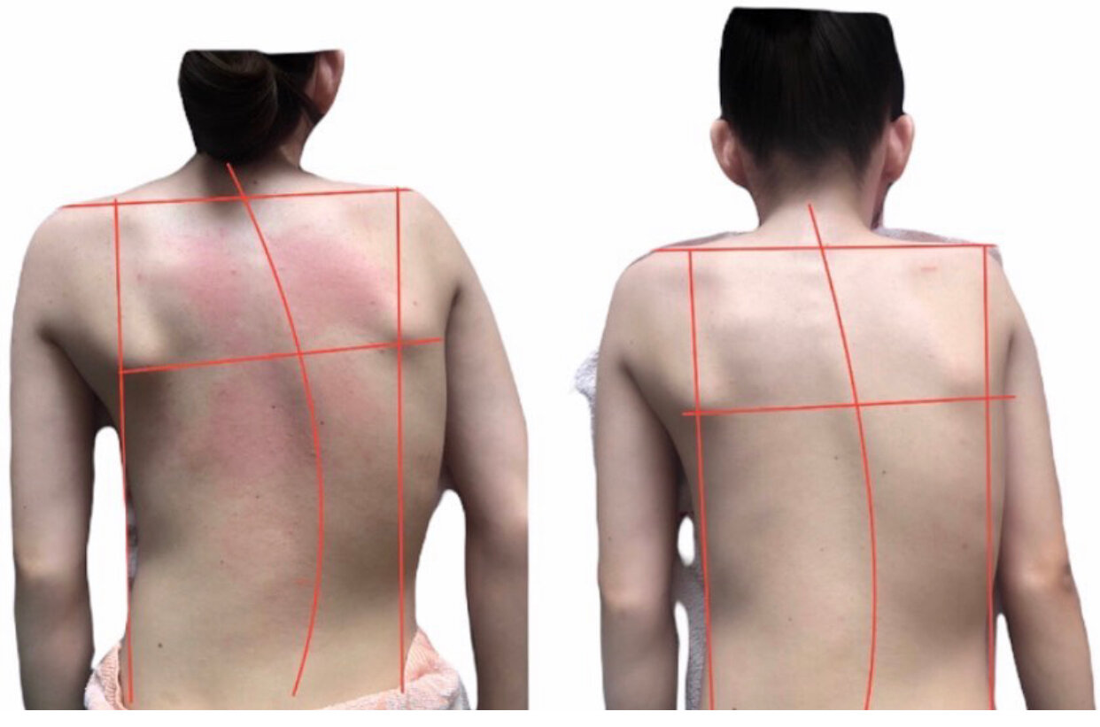 сколиоз, сколиоз кифоз грудного отдела, кифоз сколиоз позвоночника, тораколюмбальный сколиоз, е образный сколиоз 3 степени