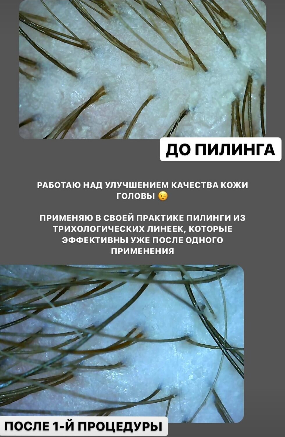 пилинг кожи головы до и после, кожа головы под микроскопом, пилинг для кожи головы, пилинг кожи головы под микроскопом, перхоть