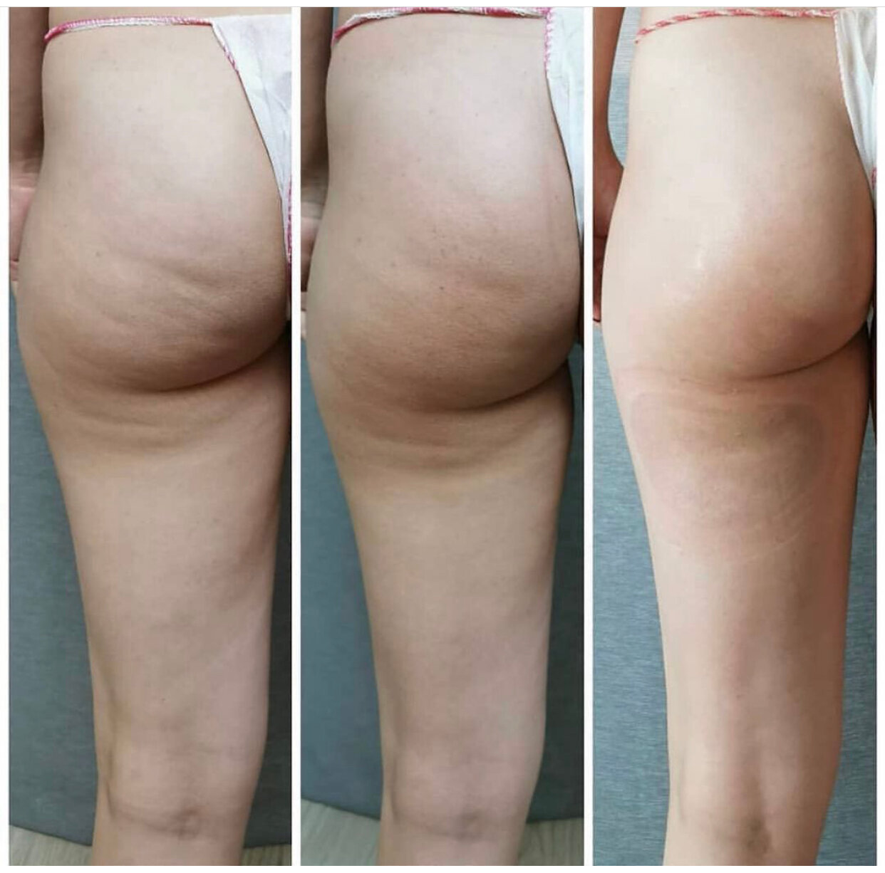 сильный целлюлит, изоджей для ягодиц, мезодренаж целлюлит, целлюлит на попе, целлюлит