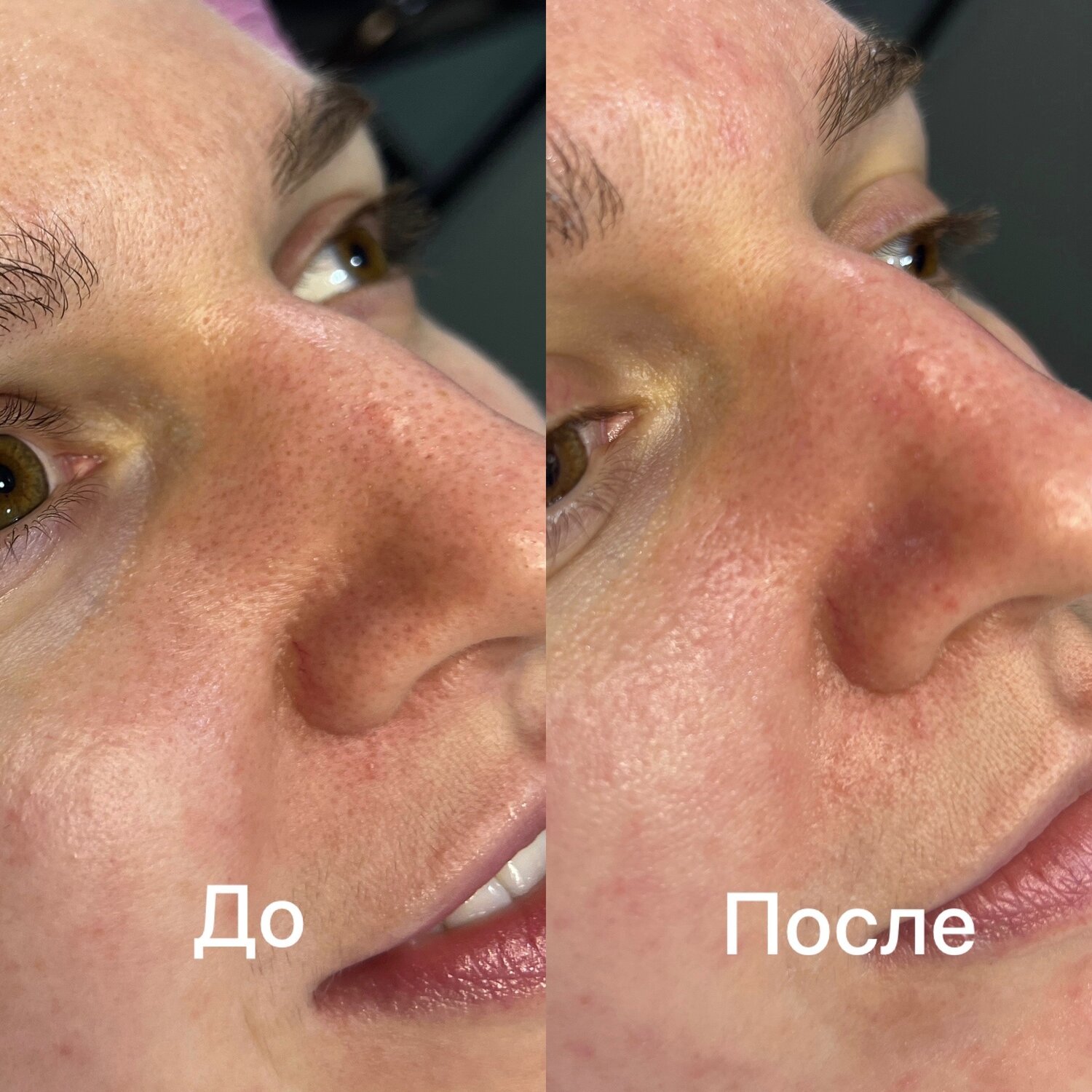 после чистки лица, уз чистка лица, чистка лица, карбоновый пилинг до и после, до и после
