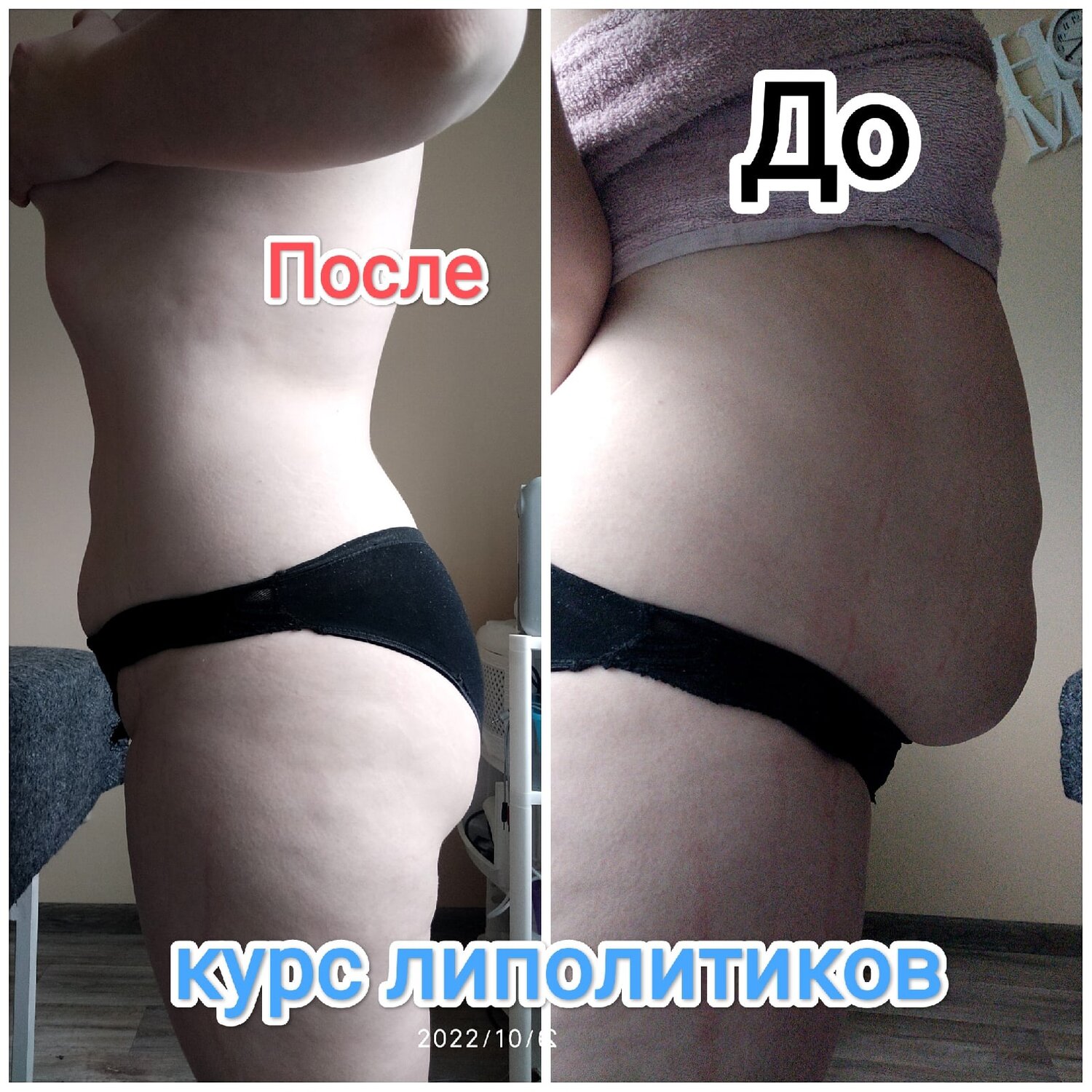 lpg массаж до и после, ульфит липолиз до и после, коррекция фигуры, миостимуляция живота до и после, липолитик