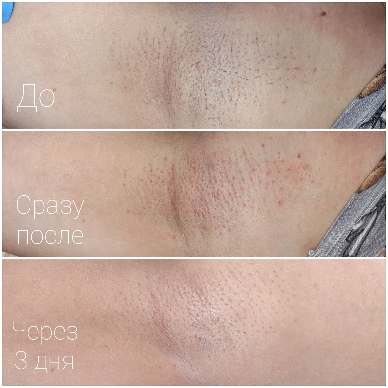 электроэпиляция подмышек до после, электроэпиляция, эпиляция классическое бикини, эпиляция глубокого бикини, бикини классика лазерная эпиляция зона