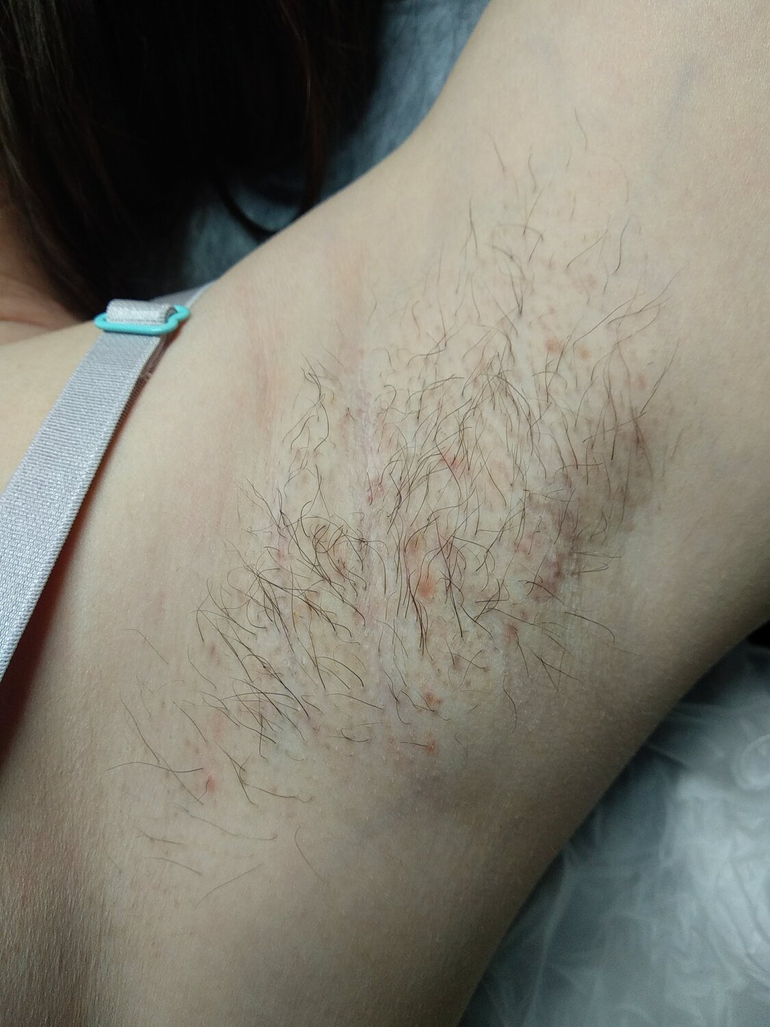 восковая депиляция, электроэпиляция, шугаринг глубокое, депиляция воском, электроэпиляция подмышек