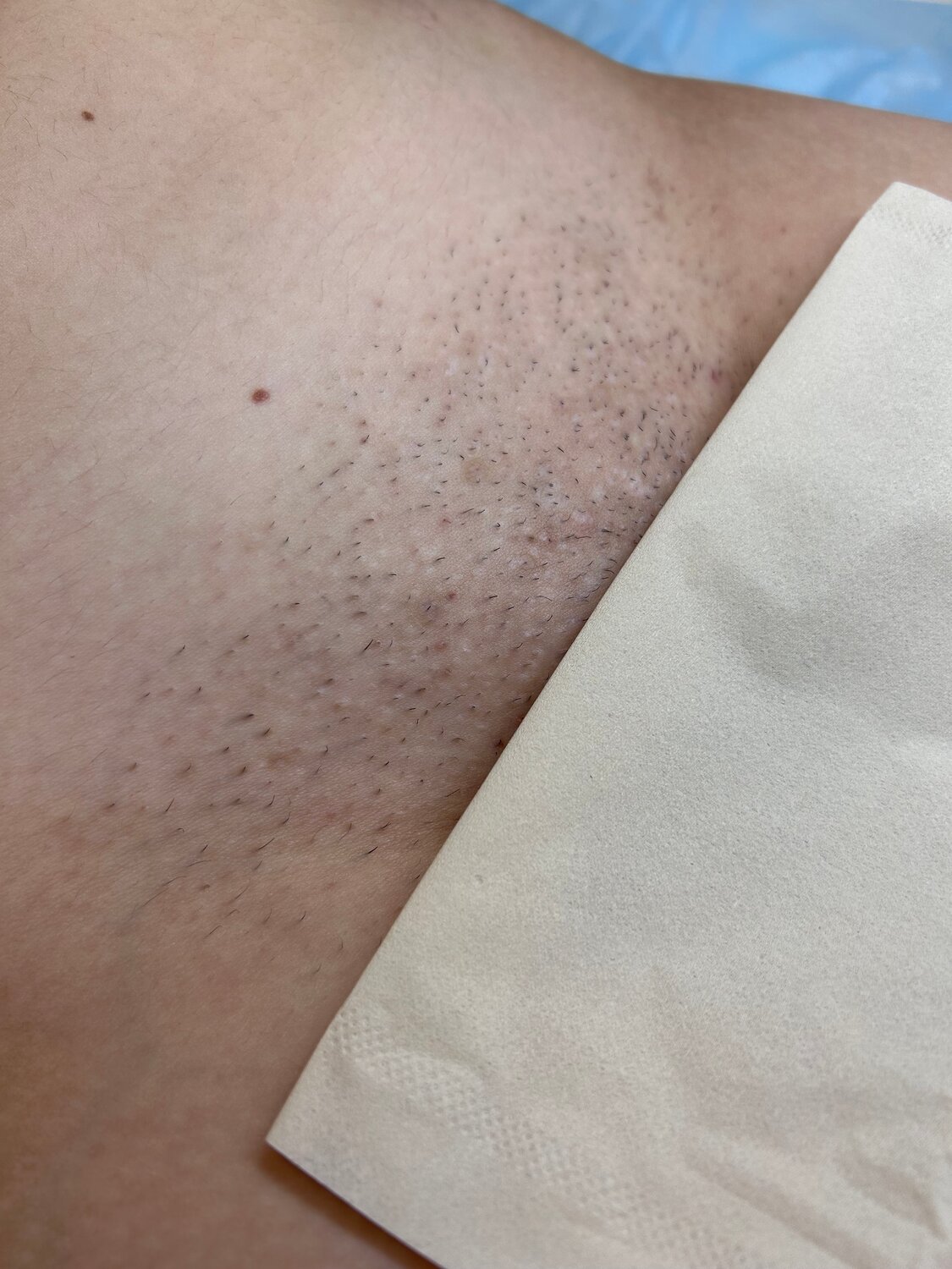 эпиляция, лазерная эпиляция, восковая депиляция, депиляция воском, эпиляция воском