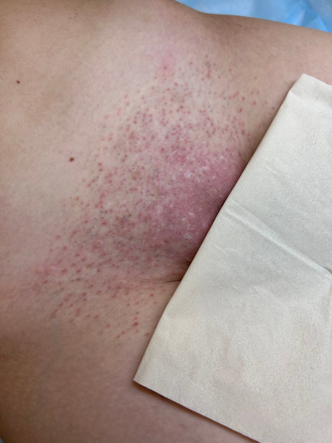 электроэпиляция, депиляции, электроэпиляция зоны бикини, бикини классика, сыпь