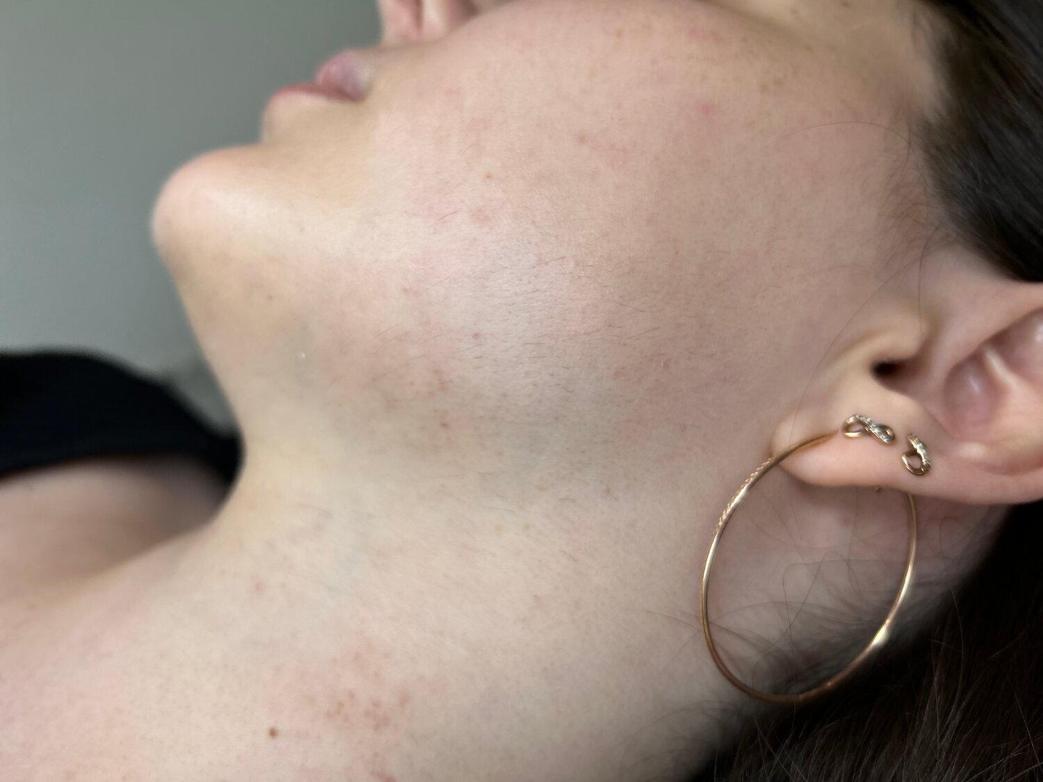 коррекция подбородка, пигментные пятна, лицо, зуд на лице, следы на коже