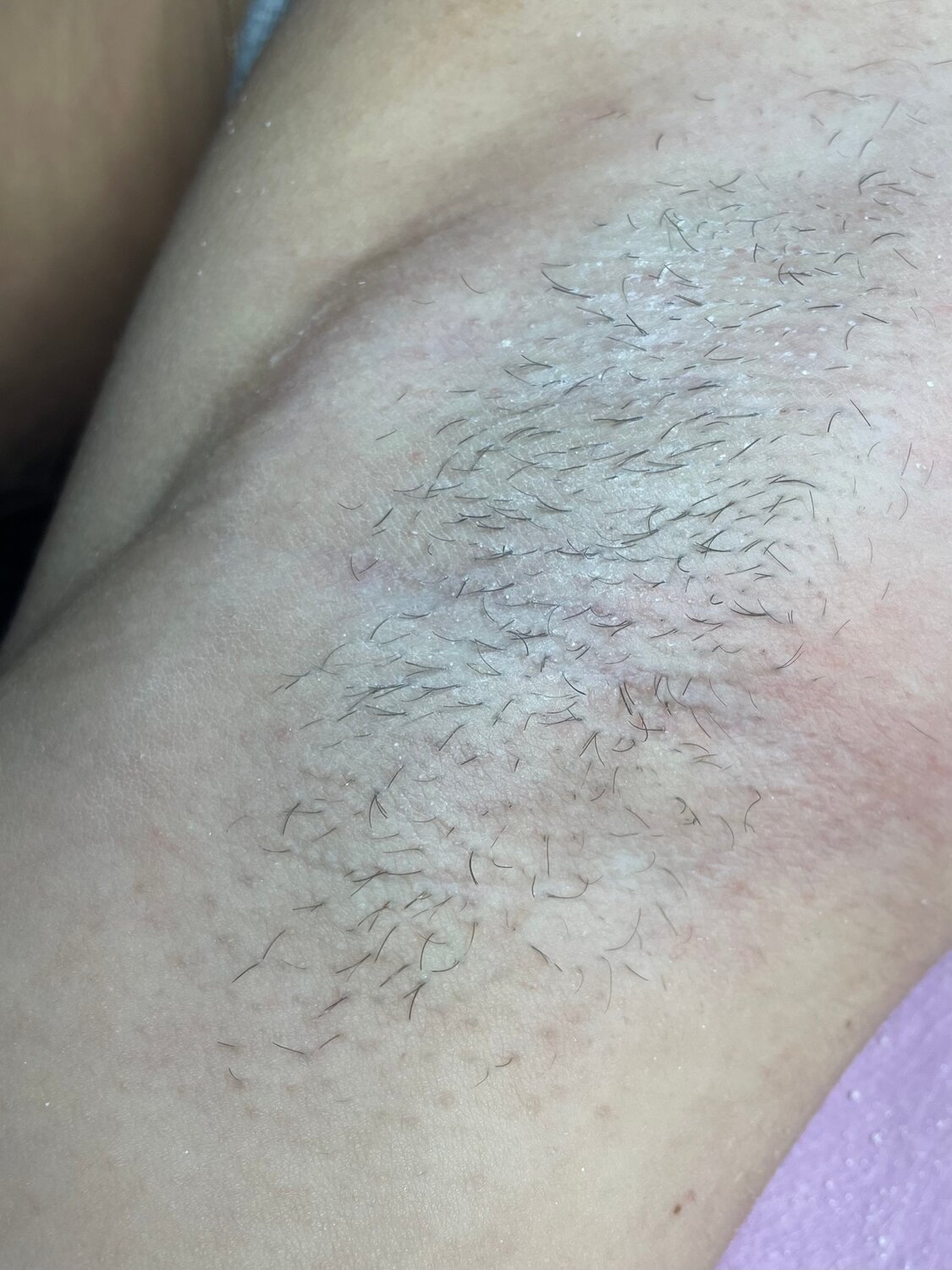 электроэпиляция, восковая депиляция, электроэпиляция бикини, депиляции, депиляция воском