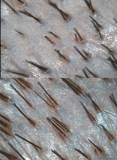 трихоскопия, фототрихограмма волос, волос под микроскопом, трихограмма волос, угри под микроскопом