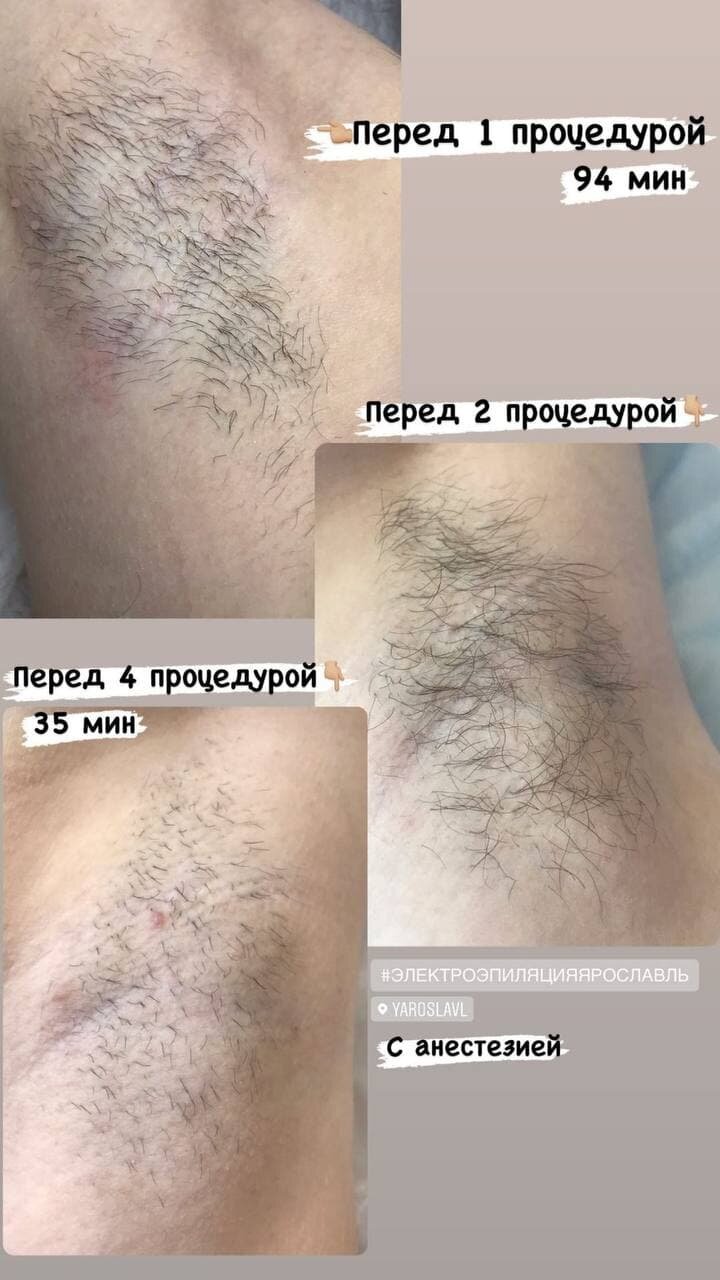 процедура лазерной эпиляции, электроэпиляция до и после первой процедуры, эпиляция, электроэпиляция, электроэпиляция глубокое бикини