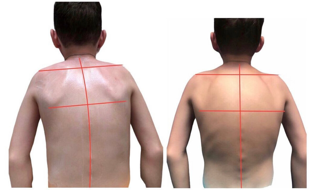 сколиоз, сколиоз кифоз грудного отдела, сколиоз, остеохондроз и протрузия, плечо, сколиоз клиника