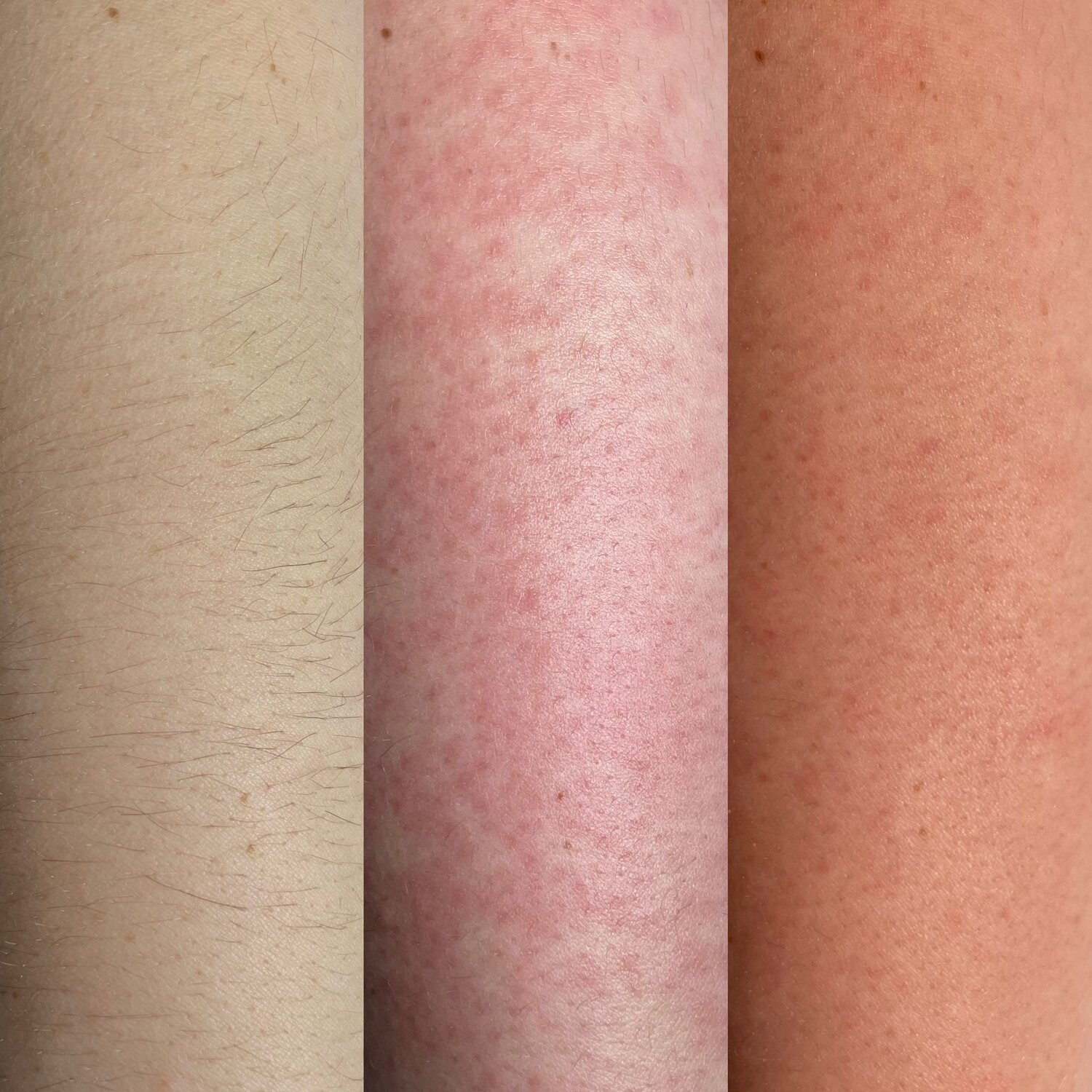 часть тела человека, тела, аллергия, аллергия после эпиляции, сыпь на теле