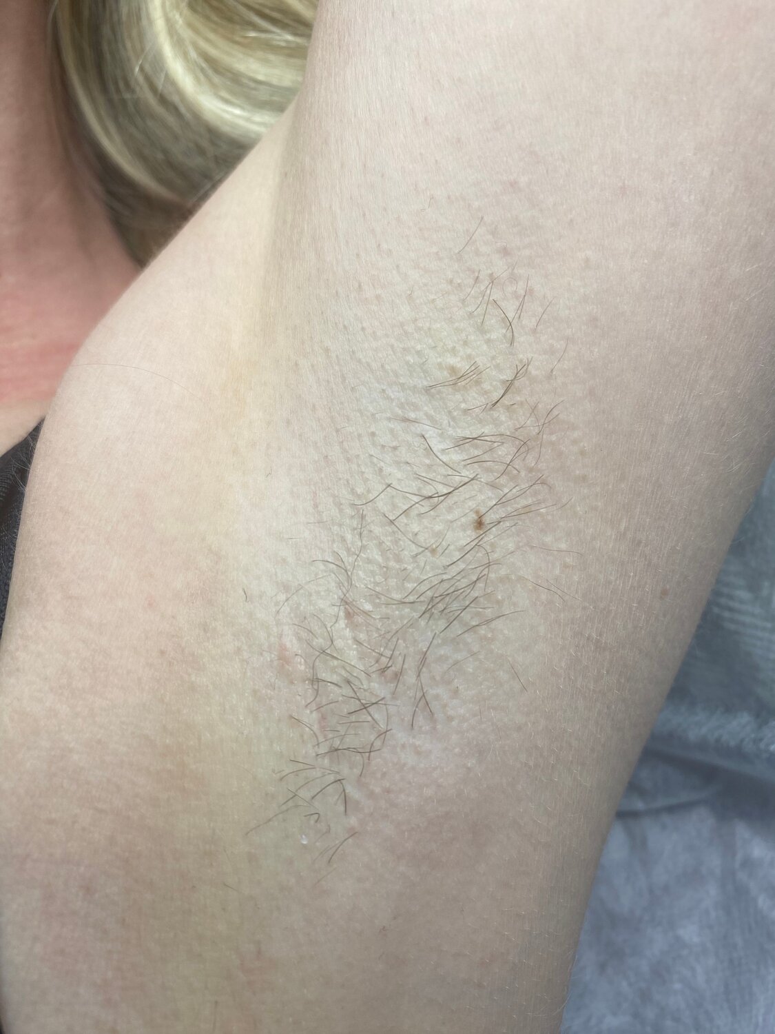 восковая депиляция, депиляция подмышек воском, депиляция подмышек, депиляция, шугаринг