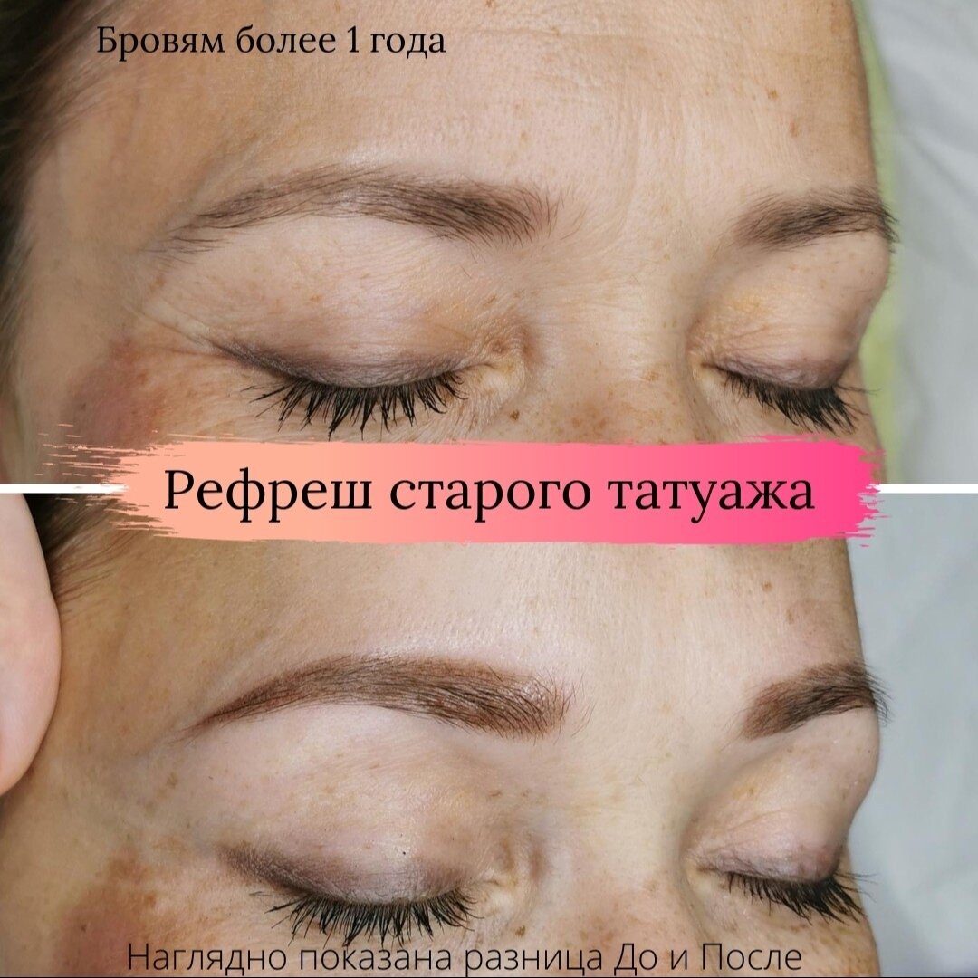 ревайвинг для удаления татуажа, выведение татуажа бровей ремувером, брови после татуажа, татуаж брови, ремувер для удаления татуажа бровей