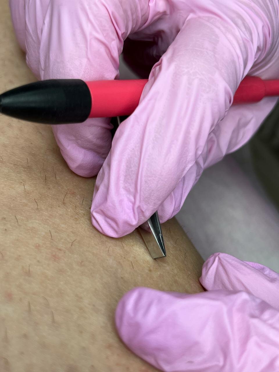 электроэпиляция, электроэпиляция в москве, электроэпиляция аппарат, аппарат для электроэпиляции, электроэпиляция зоны бикини