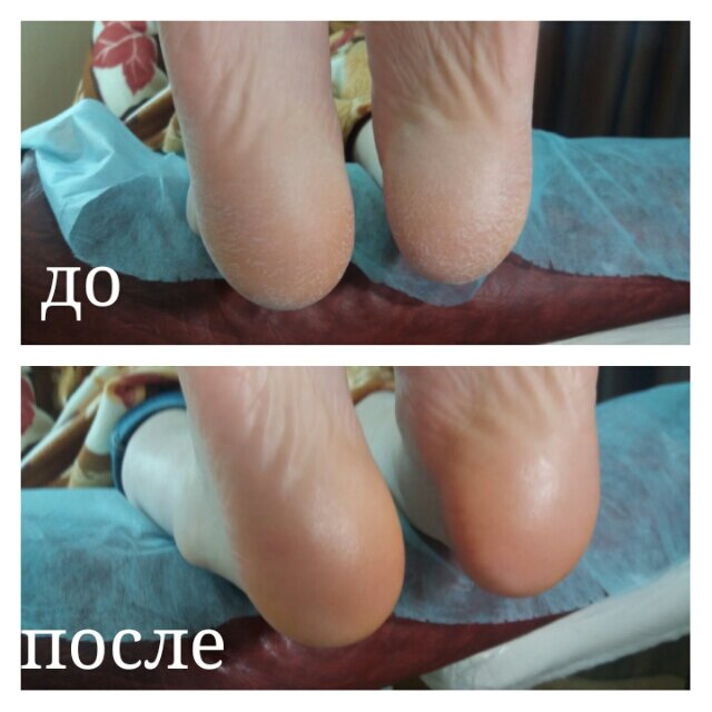 Аппаратный педикюр