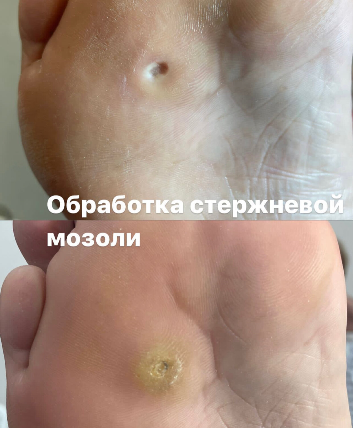мозоль стержневая, удаление стержневой мозоли, стержневая мозоль лечение, стержневая мозоль или бородавка, стержневая мозоль на стопе