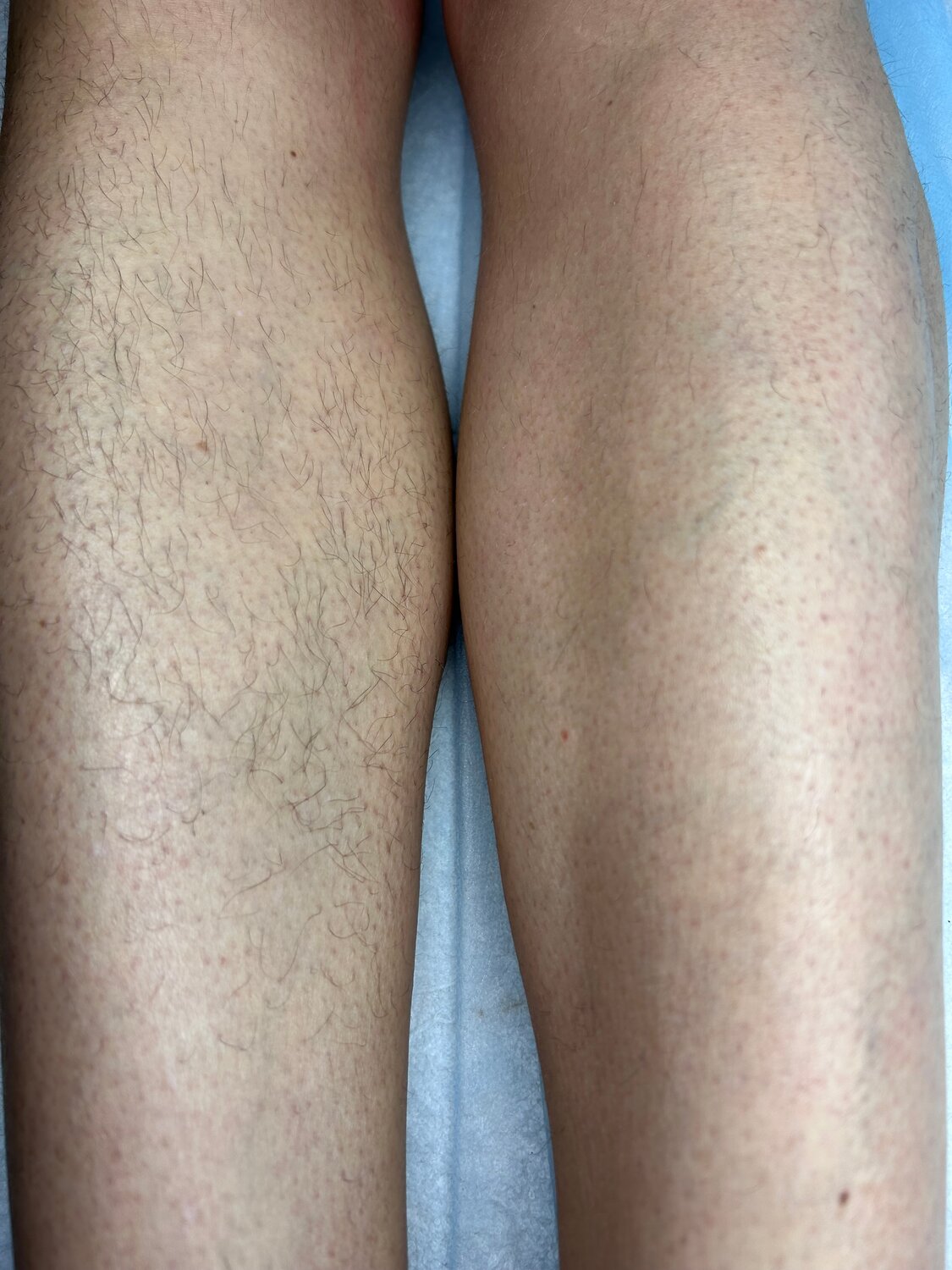 депиляция, восковая депиляция, волосы на ногах, шугаринг, шугаринга