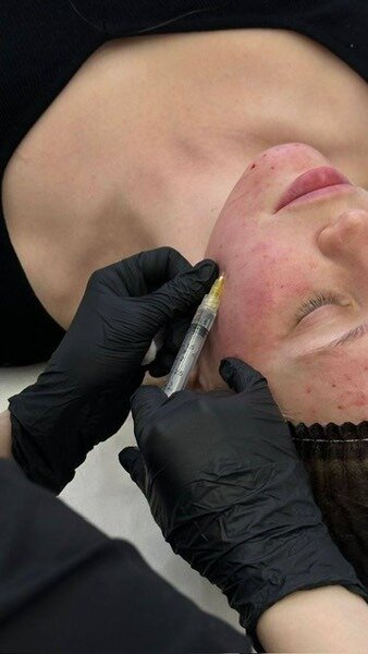 плазмолифтинг для лица, мезотерапия лица, наппаж техника мезотерапии, биоревитализации лица, плазмалифтинг
