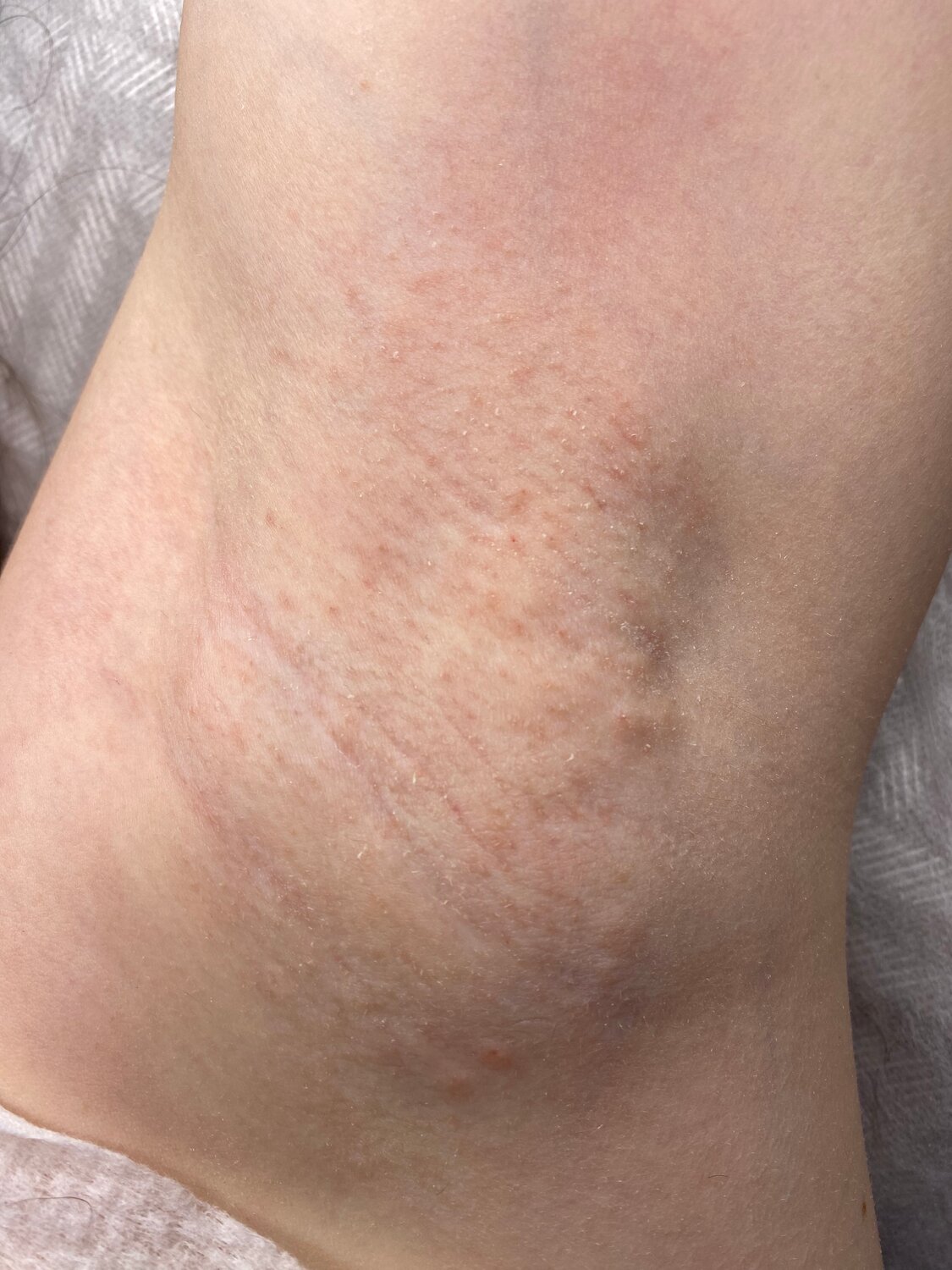 женская депиляция, дерматит, сыпь, шугаринг глубокое, крапивница