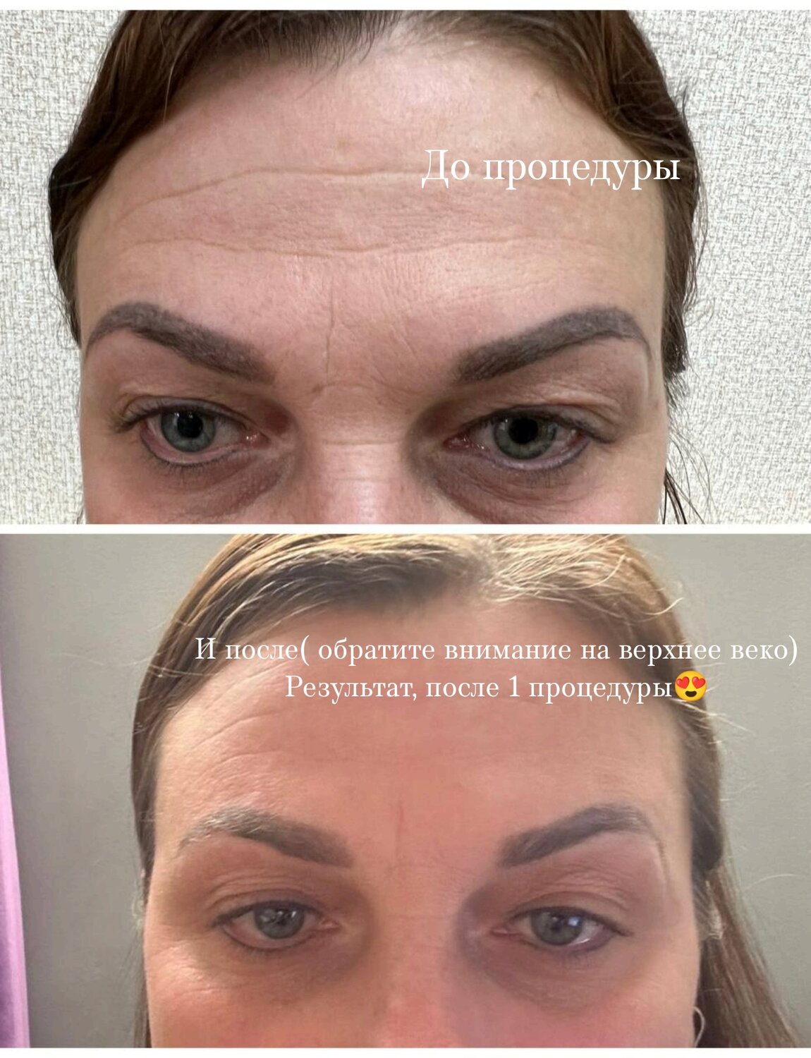 после перманента бровей, брови, пересадка бровей, перманент бровей, татуаж бровей