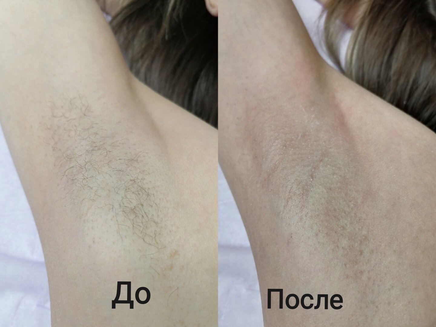 восковая депиляция, депиляцию, эпиляция, депиляция шугаринг, сахарная депиляция