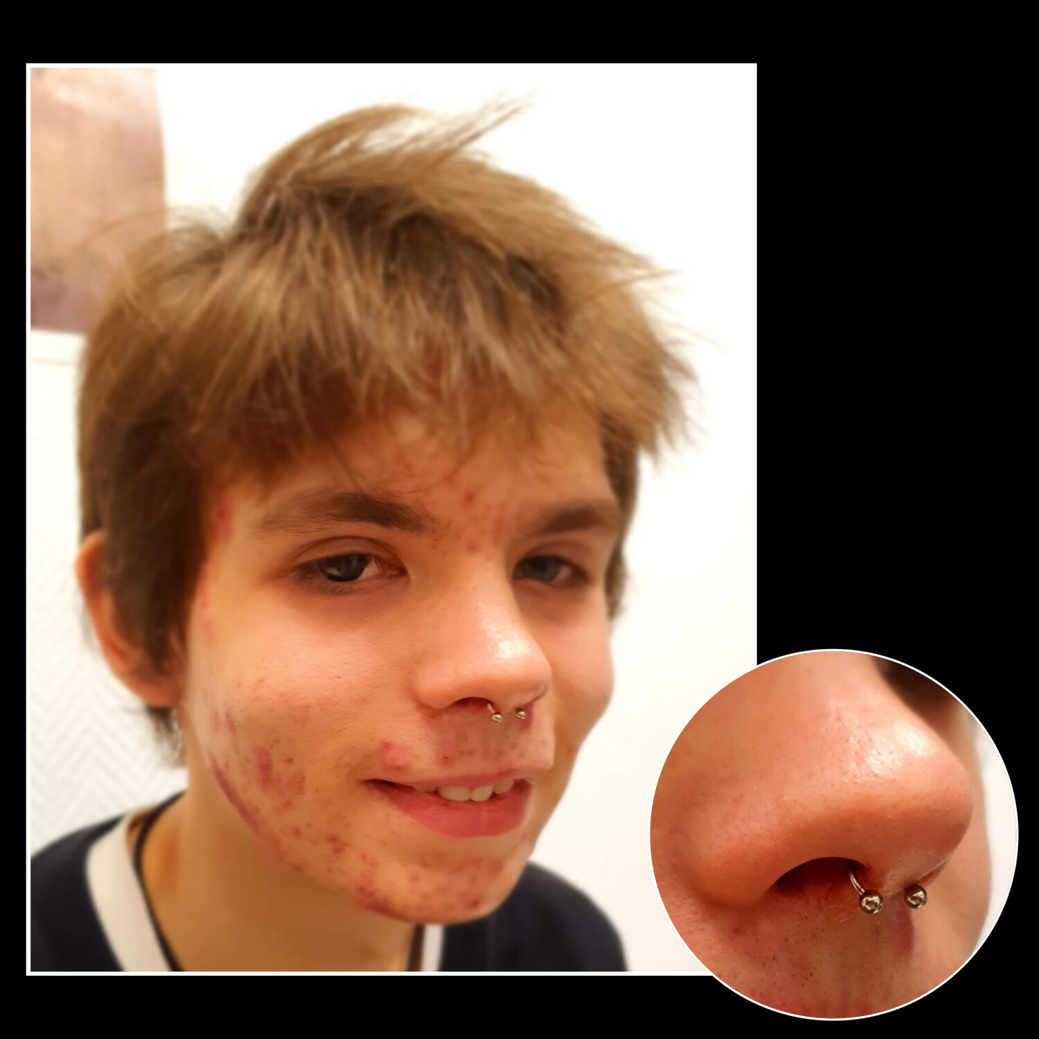 пирсинг носа, пирсинг, септум прокол гноится, неправильно проколотый септум, прокол носа