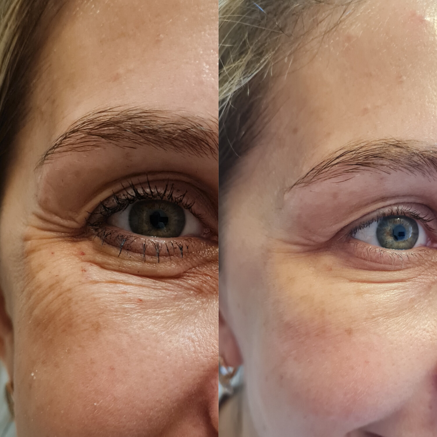 безинъекционная блефаропластика век, лазерная блефаропастика "smooth eye", лазерная блефаропластика век, безоперационная блефаропластика век, co2 лазер безоперационная блефаропластика