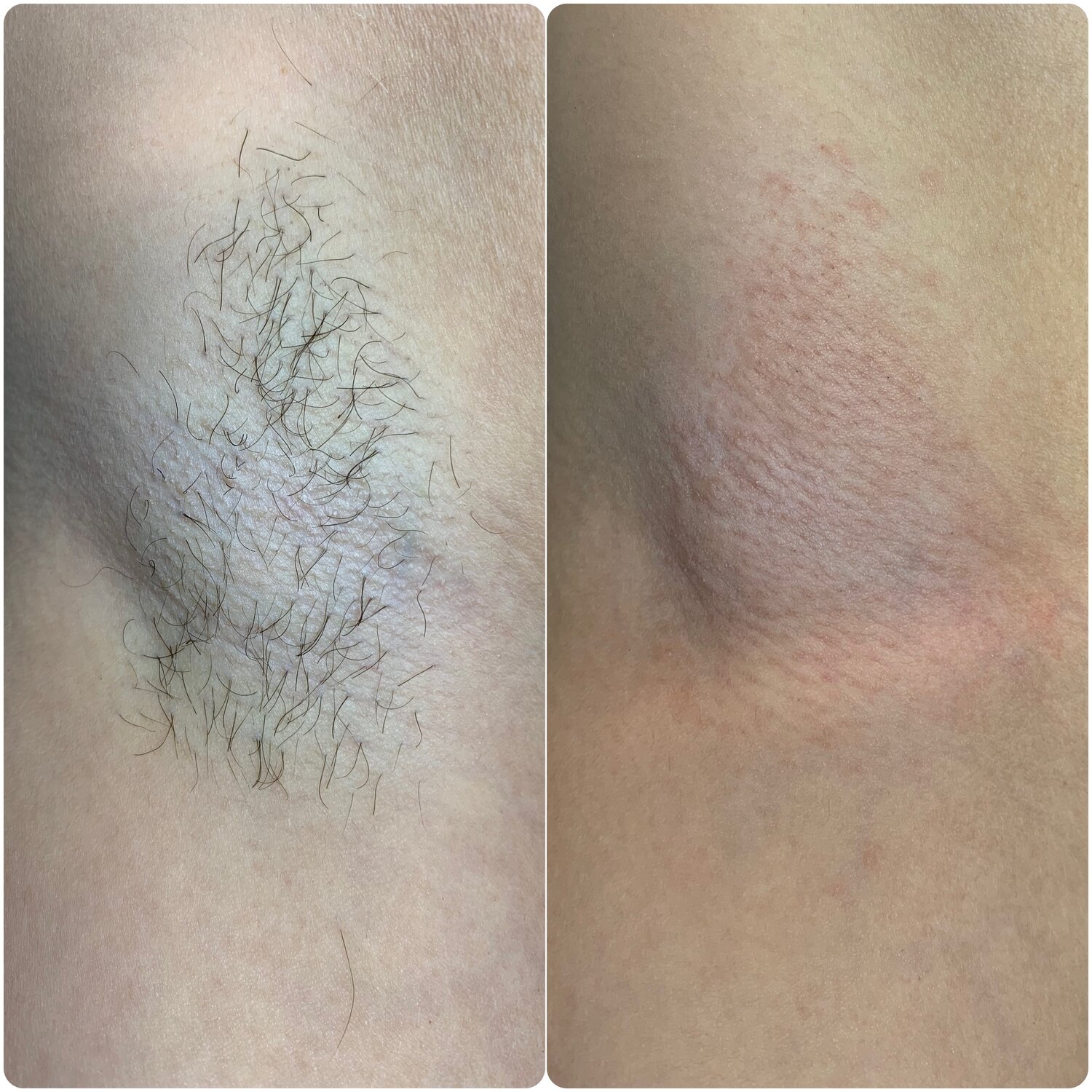 шугаринг, электроэпиляция в ростове-на-дону, электроэпиляция, депиляция, электроэпиляция глубокого бикини