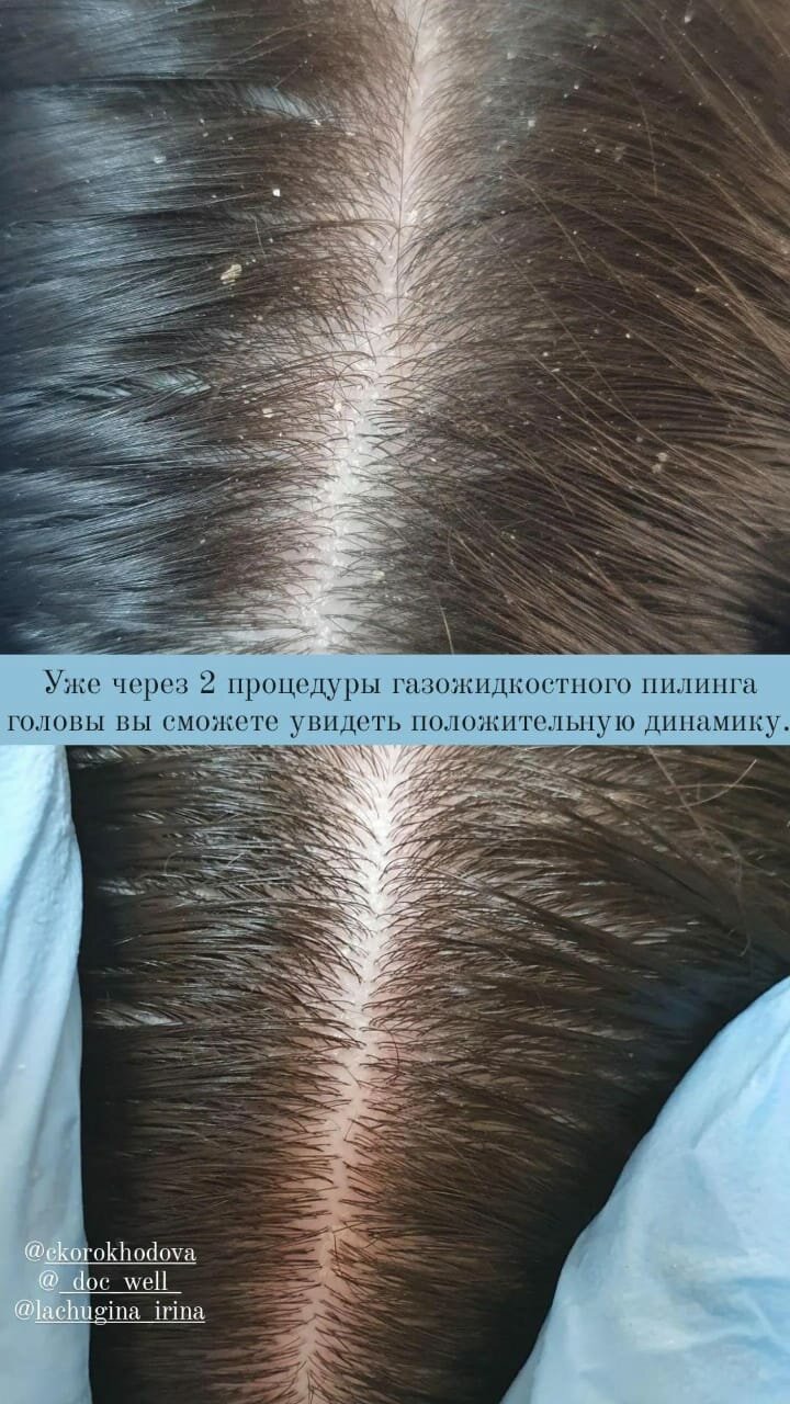 перхоть, касторовое масло для волос от перхоти, перхоть на голове, перхоть на волосах, пилинг для волос и кожи головы