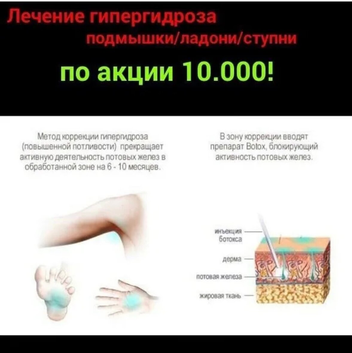 дистальный гипергидроз, лечение гипергидроза, гипергидроз подмышек, гипергидроз подмышек лечение, что такое гипергидроз