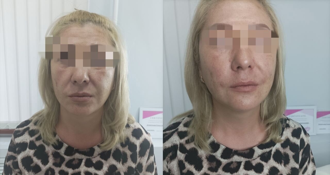 нити подтяжка лица, подтяжка лица без операции, рф лифтинг, круговая подтяжка лица, подтяжка лба нитями аптос