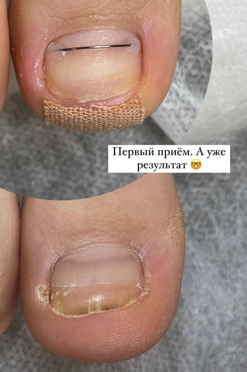 педикюр, исправление вросшего ногтя, ногтевая пластина, ногти, лечение вросшего ногтя