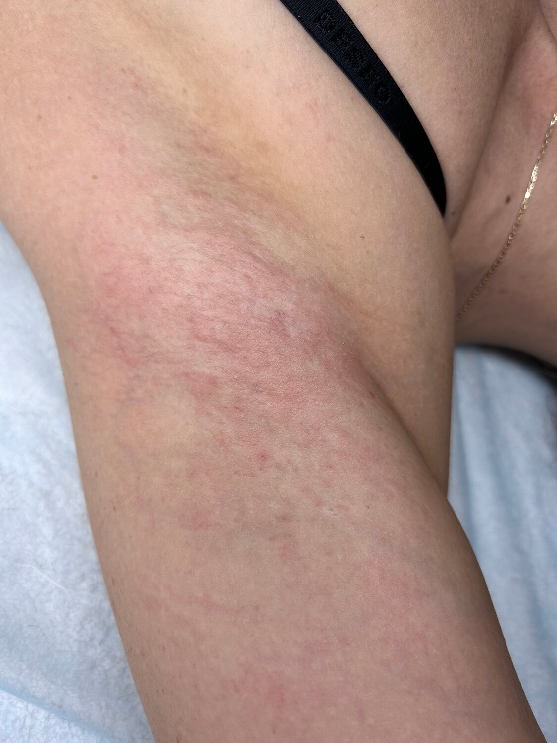 электроэпиляция, лазерная эпиляция, эпиляция, шугаринга, шугаринг депиляция